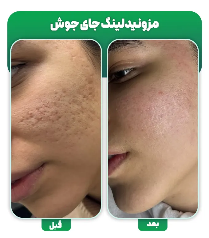 مزونیدلینگ جای جوش