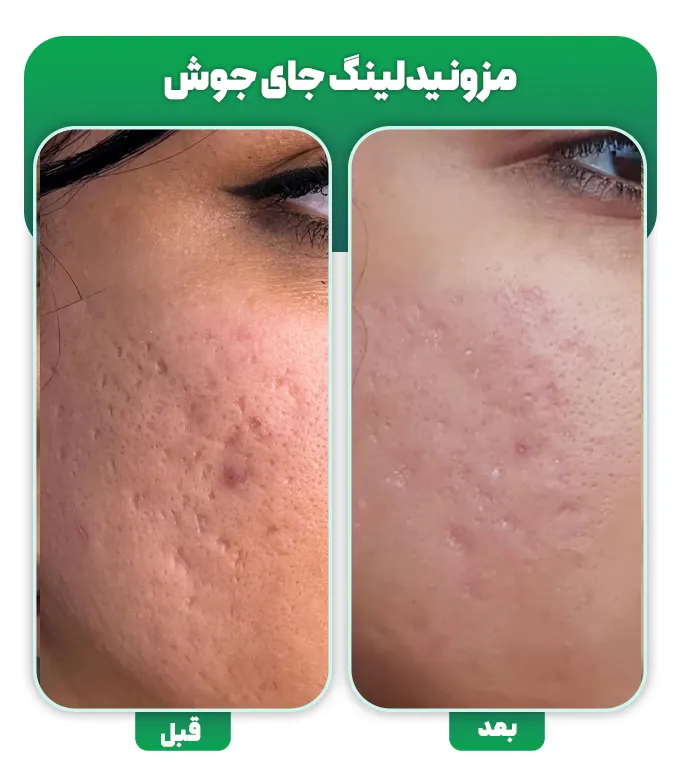 مزونیدلینگ جای جوش