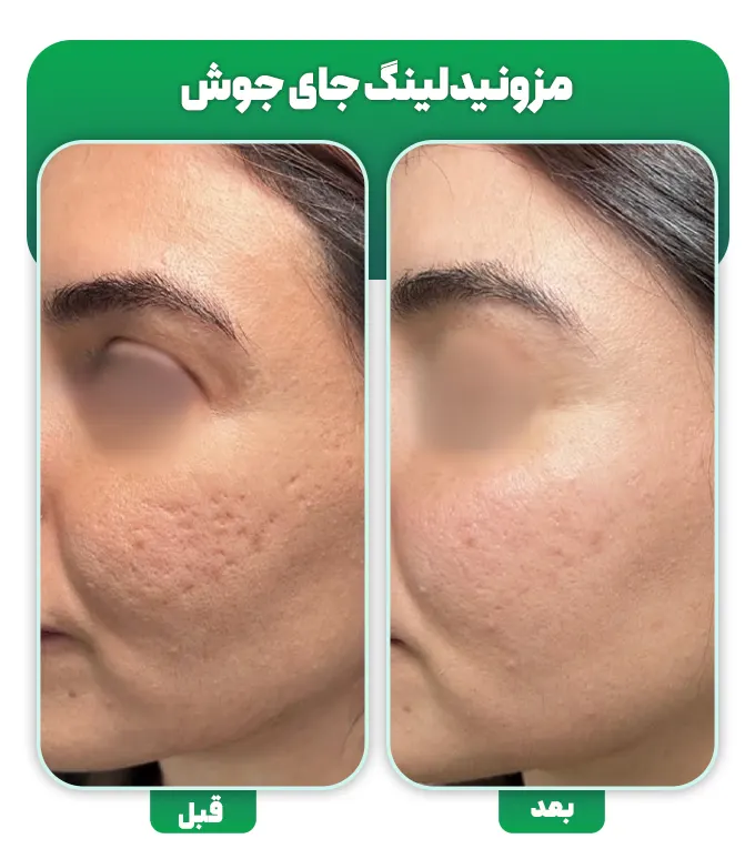 مزونیدلینگ اسکار جای جوش