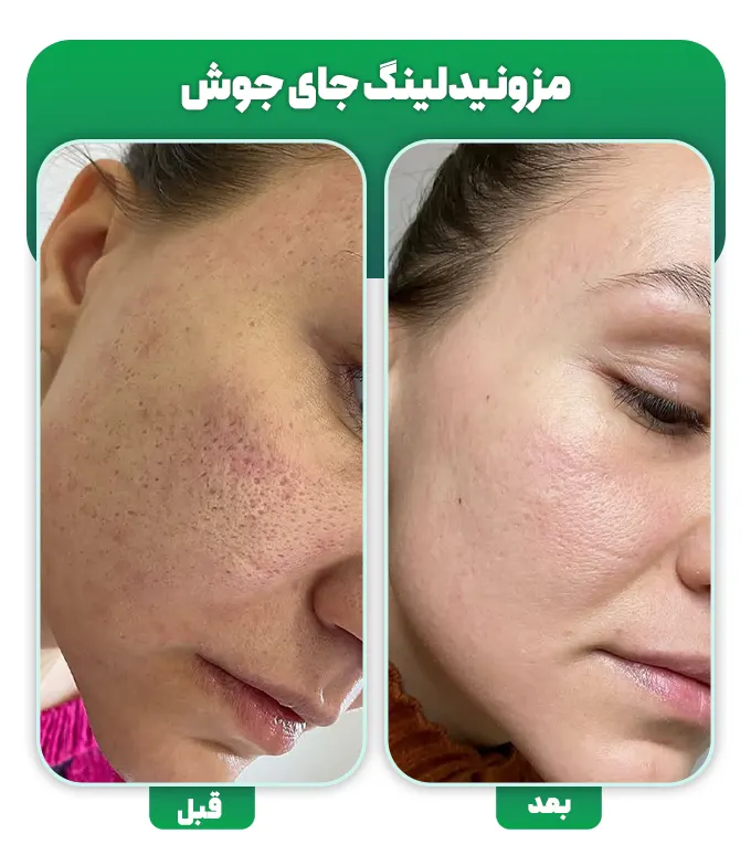 مزونیدلینگ جای جوش