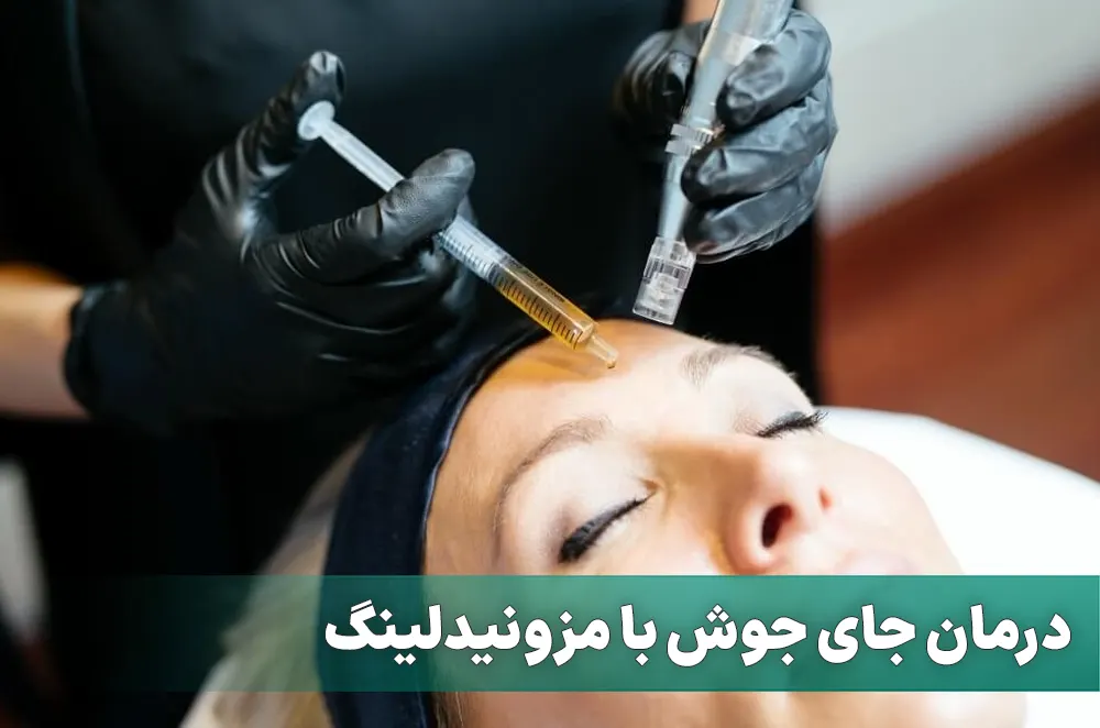 مزونیدلینگ جای جوش