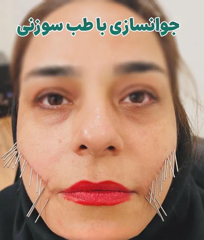 طب سوزنی برای جوانسازی
