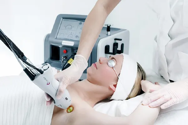 تخفیف لیزر موهای زائد