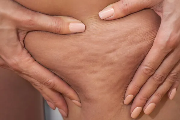 تخفیف رفع سلولیت