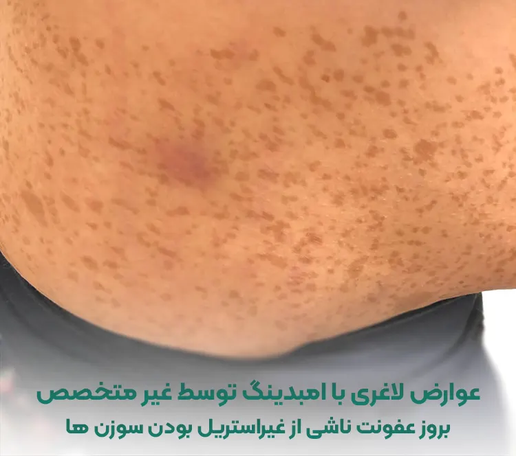 عوارض لاغری با امبدینگ