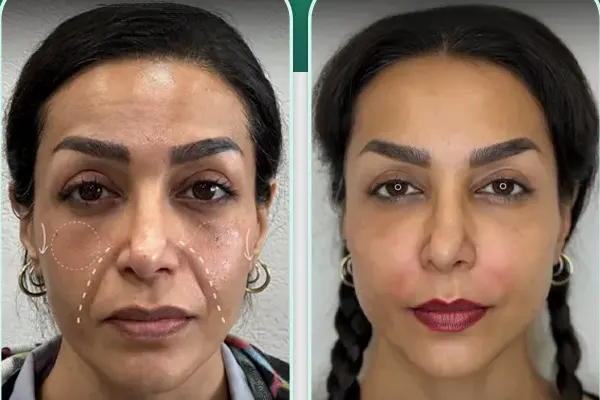 کانتورینگ صورت