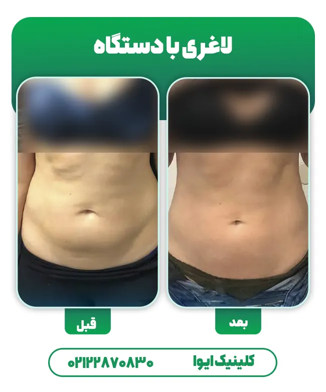 لاغری موضعی شکم