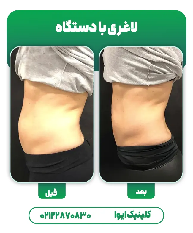 لاغری موضعی شکم