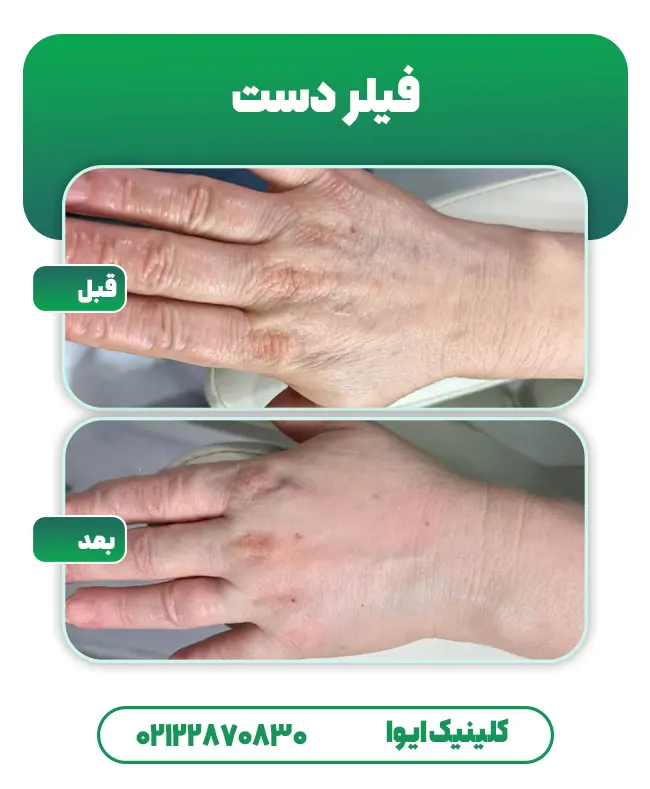 تزریق فیلر دست قبل و بعد