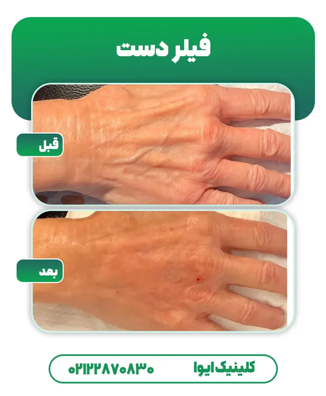 تزریق فیلر دست قبل و بعد