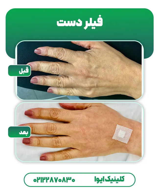 تزریق فیلر دست