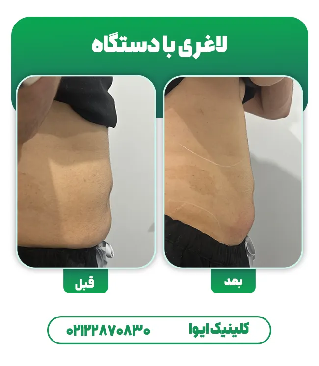 کانتورینگ بدن بدون جراحی
