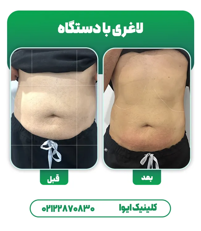 کانتورینگ بدن بدون جراحی