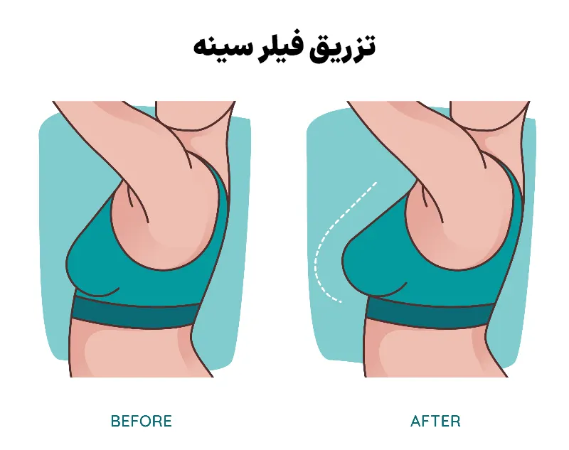 تزریق فیلر سینه