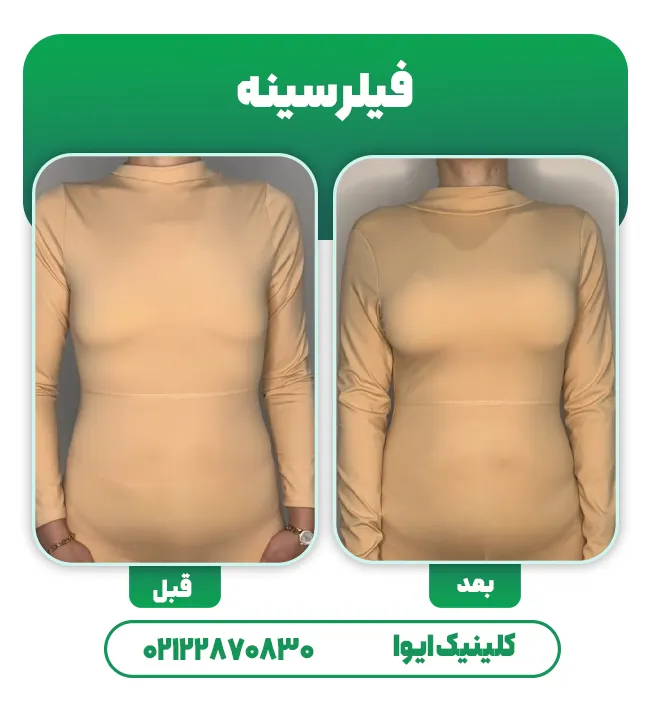 قبل و بعد فیلر سینه