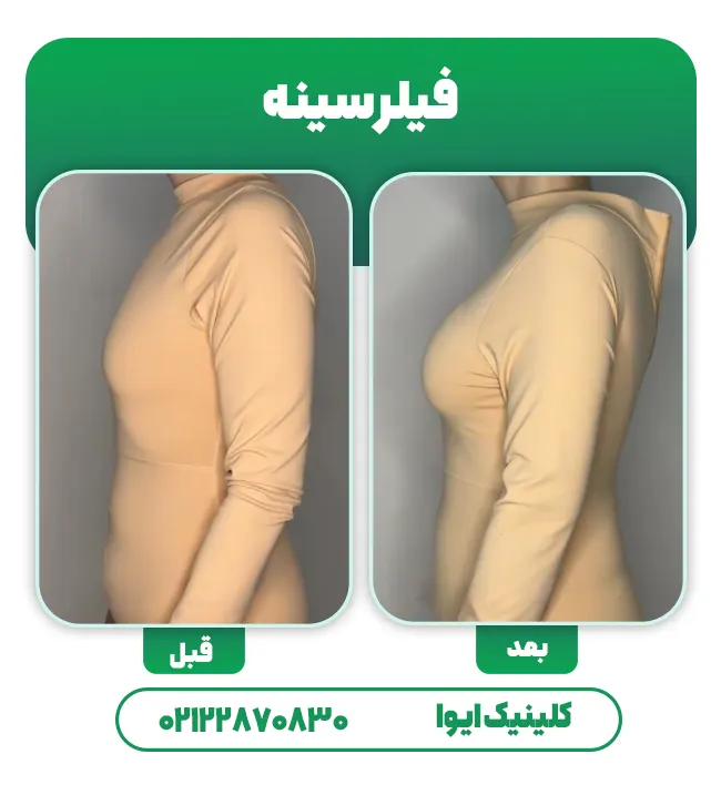 قبل و بعد فیلر سینه