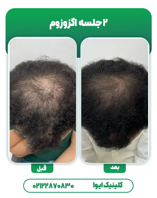 اگزوزوم تراپی مو