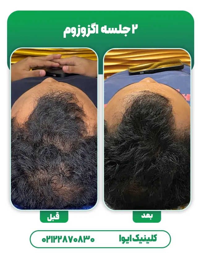 اگزوزوم تراپی مو