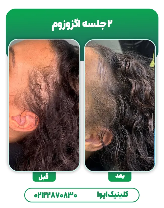اگزوزوم تراپی مو