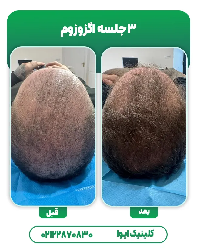 اگزوزوم تراپی مو