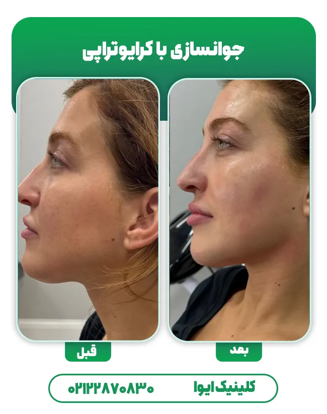 کرایوتراپی صورت