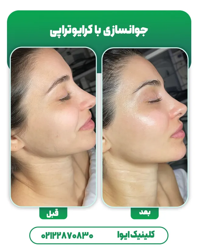 کرایوتراپی صورت