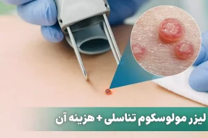 لیزر مولوسکوم تناسلی