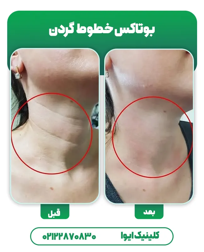 تزریق بوتاکس گردن