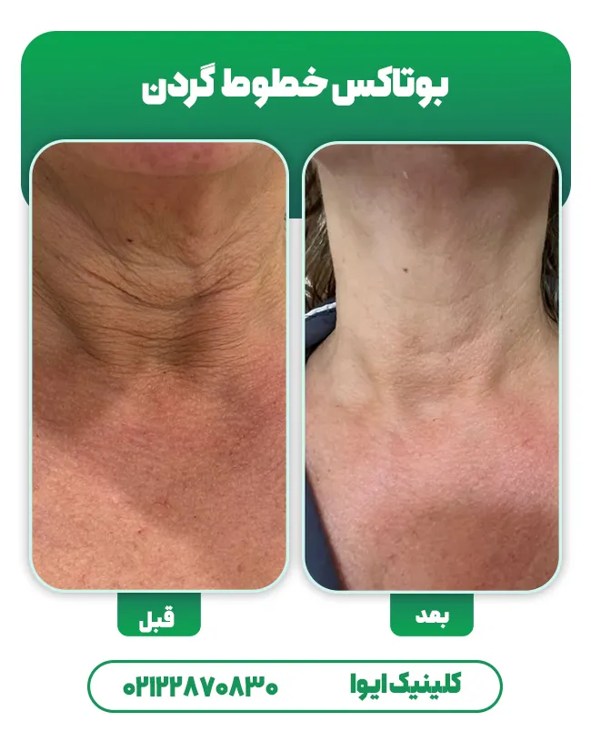 قبل بعد بوتاکس گردن