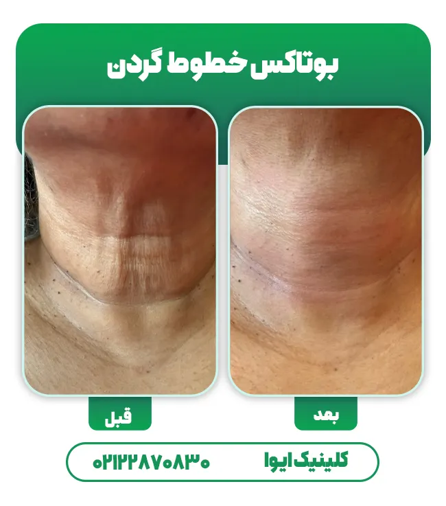 قبل بعد بوتاکس گردن