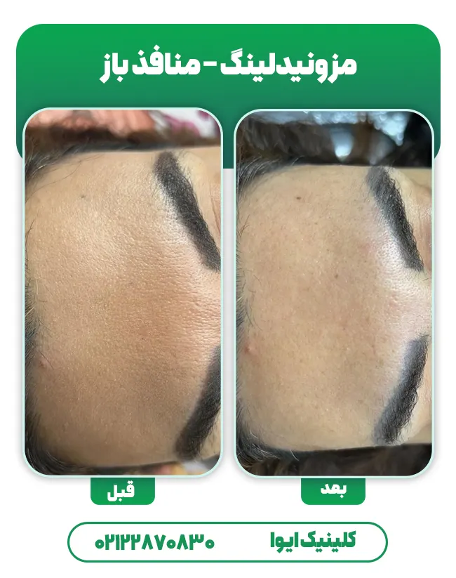 مزونیدلینگ منافذ باز پوست