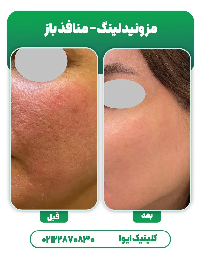 مزونیدلینگ منافذ باز پوست