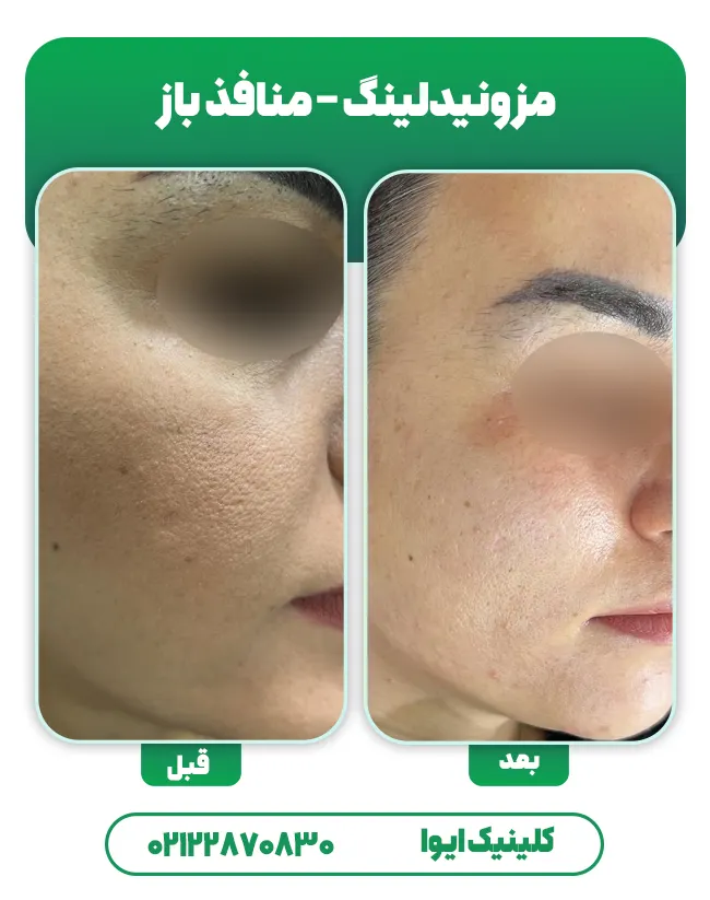 مزونیدلینگ منافذ باز پوست