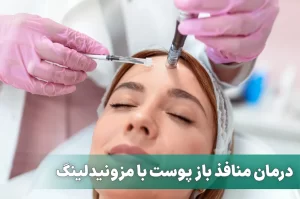 مزونیدلینگ برای درمان منافذ باز پوست