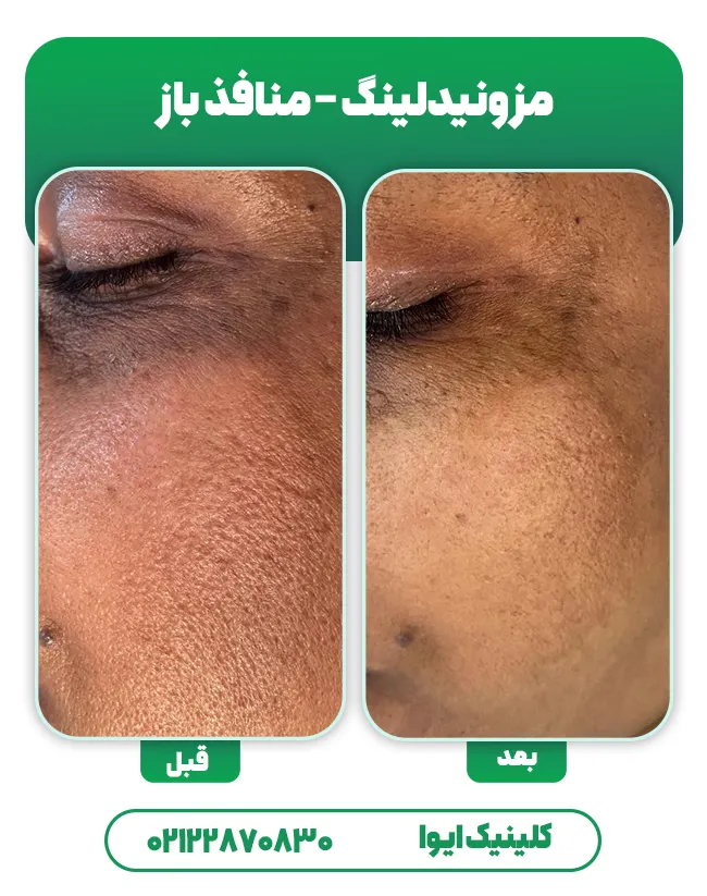 مزونیدلینگ منافذ باز پوست