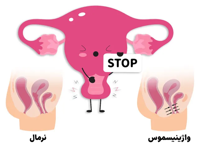 واژینیسموس