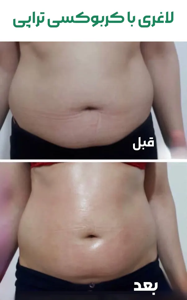 لاغری با کربوکسی تراپی