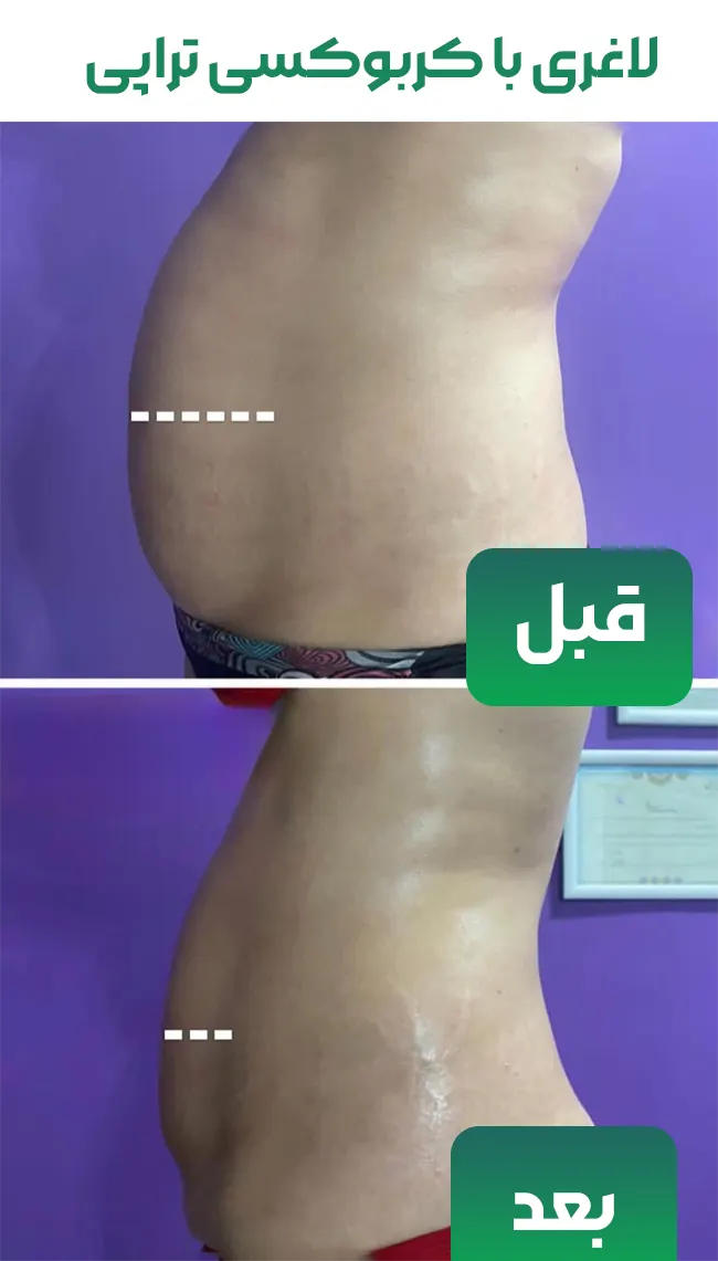 لاغری با کربوکسی تراپی