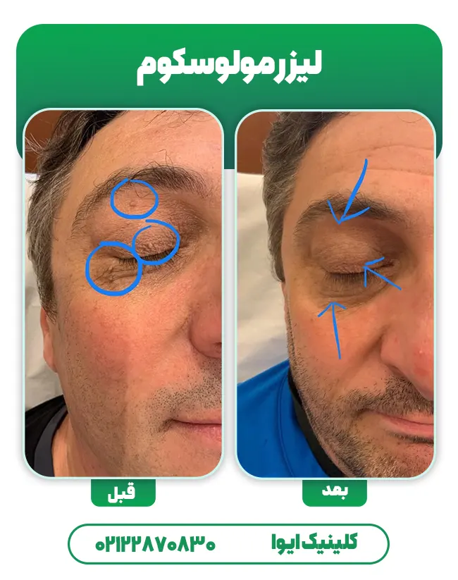 لیزر مولوسکوم