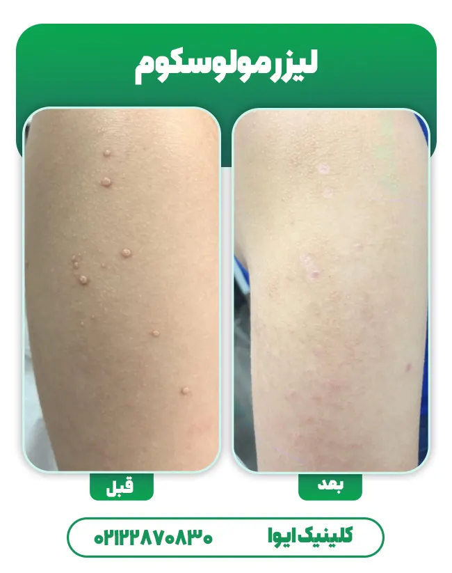 لیزر مولوسکوم