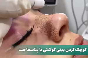 کوچک کردن بینی گوشتی با پلاسما جت