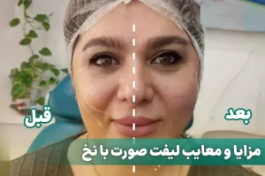 مزایا و معایب لیفت صورت با نخ