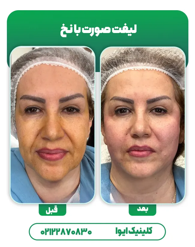 لیفت صورت با نخ