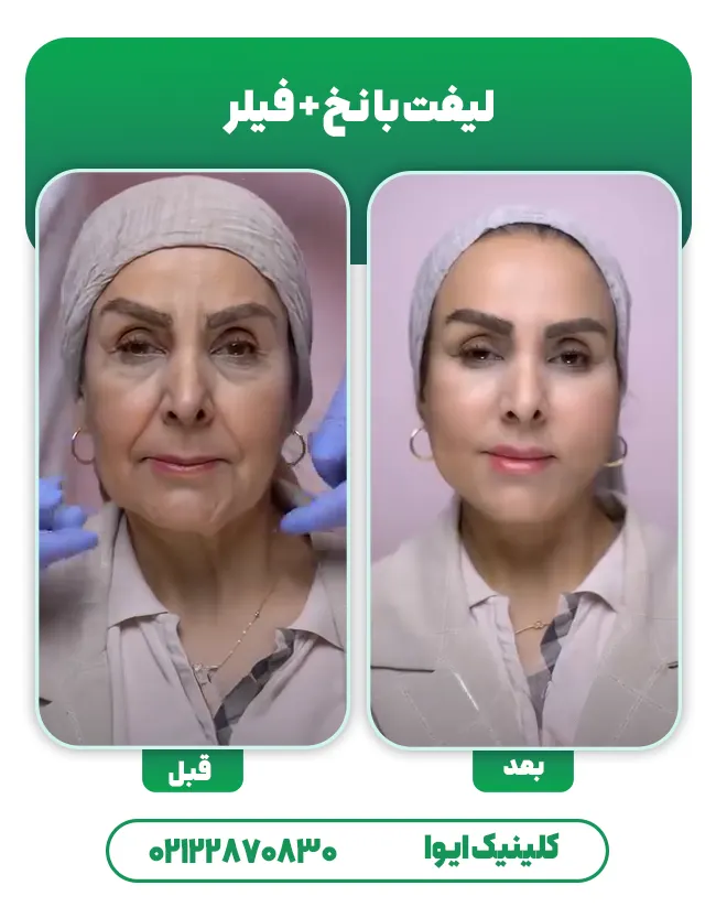 لیفت صورت با نخ