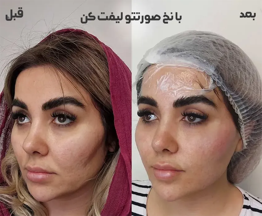 لیفت صورت با نخ