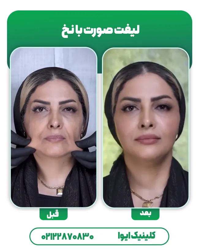 لیفت صورت با نخ