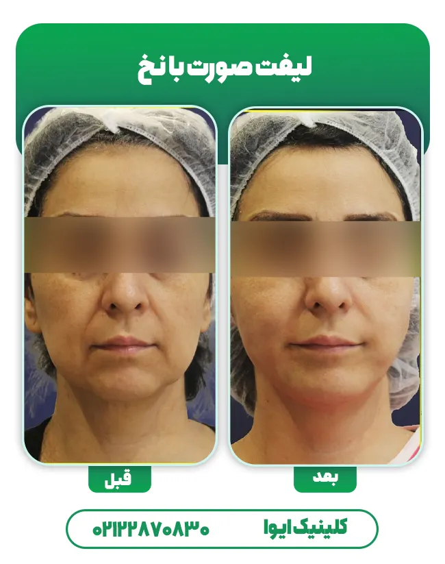 لیفت صورت با نخ