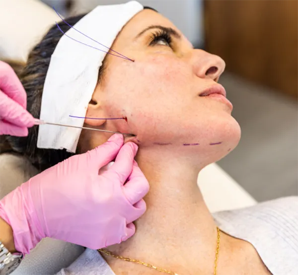 لیفت صورت با نخ