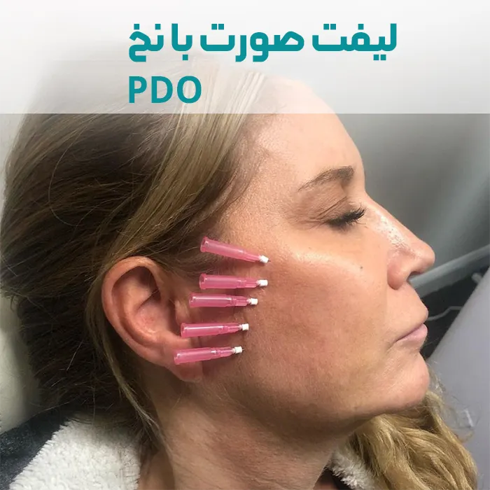 لیفت صورت با نخ PDO