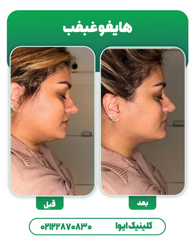 قبل و بعد هایفو غبغب